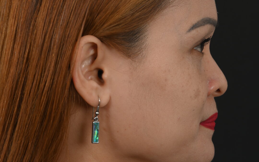 Female Asian rhinoplasty patient, before and after nose surgery by Houston nose surgeon Dr. Michel Siegel