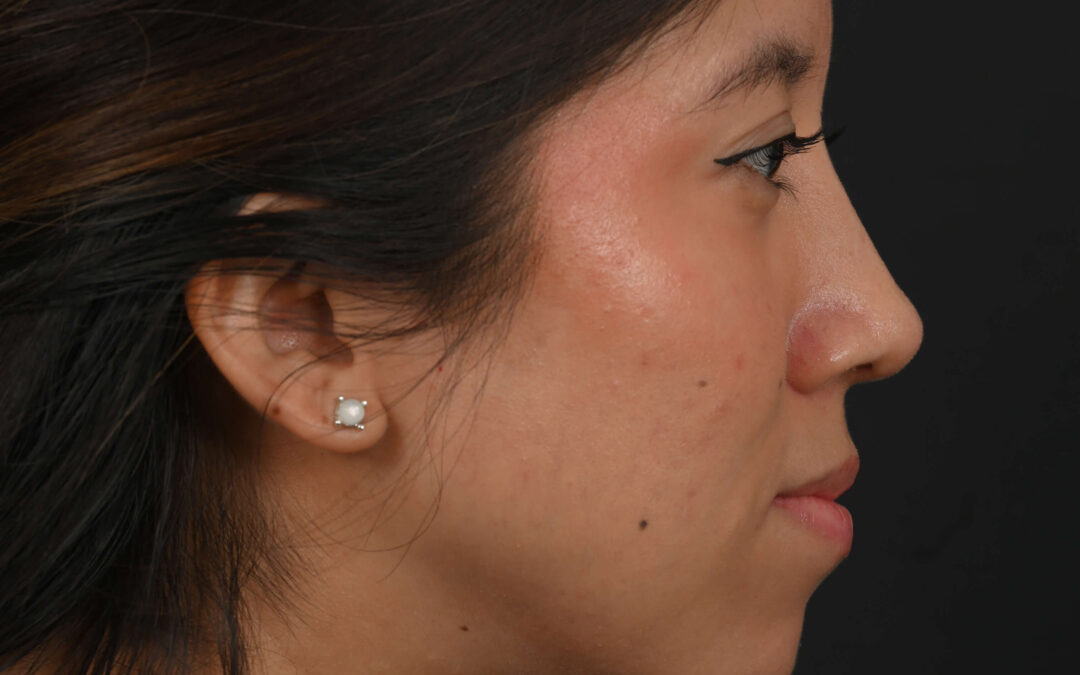 Latina rhinoplasty patient, before and after nose surgery by Houston nose surgeon Dr. Michel Siegel
