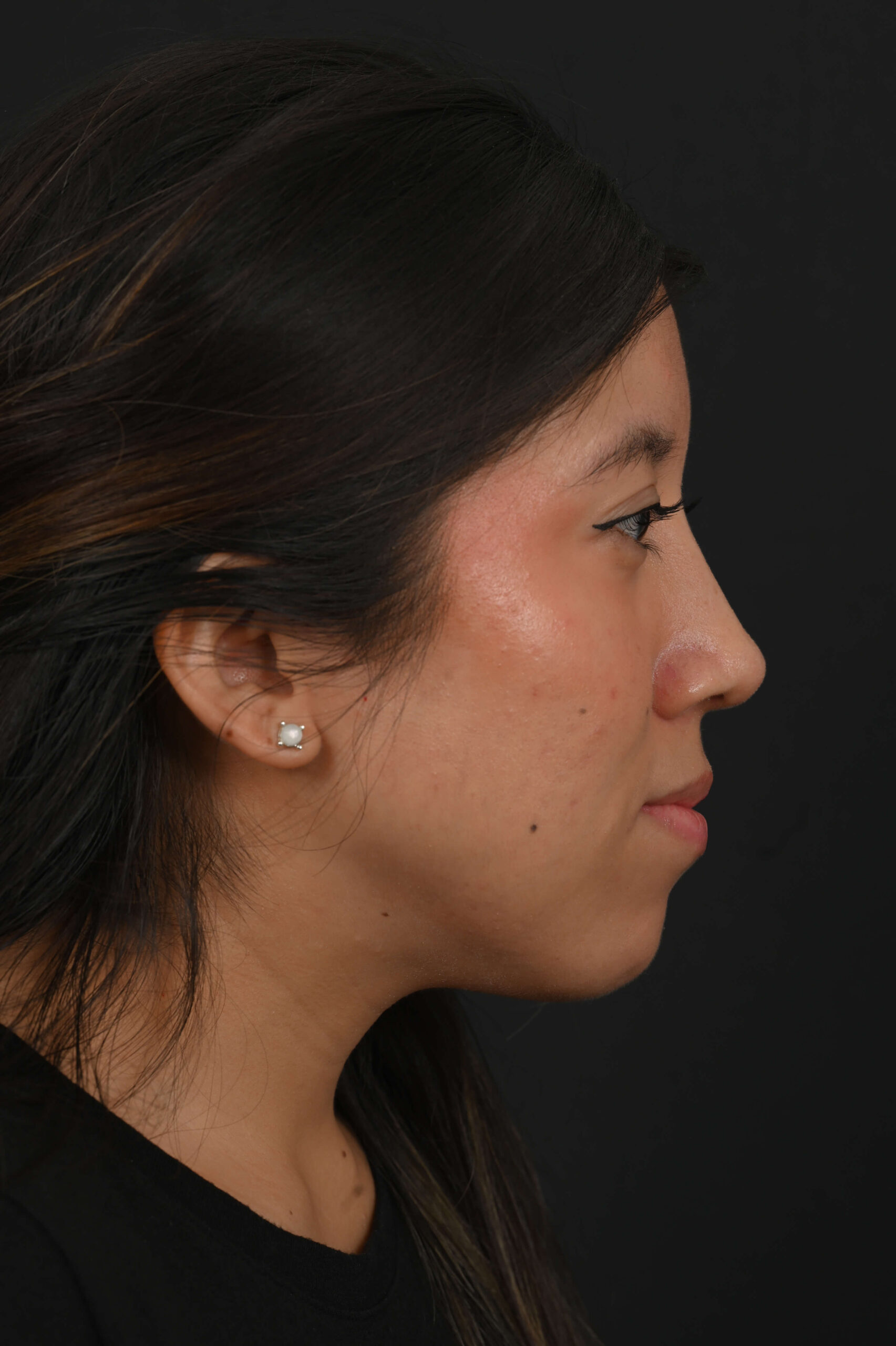 Latina rhinoplasty patient, before and after nose surgery by Houston nose surgeon Dr. Michel Siegel