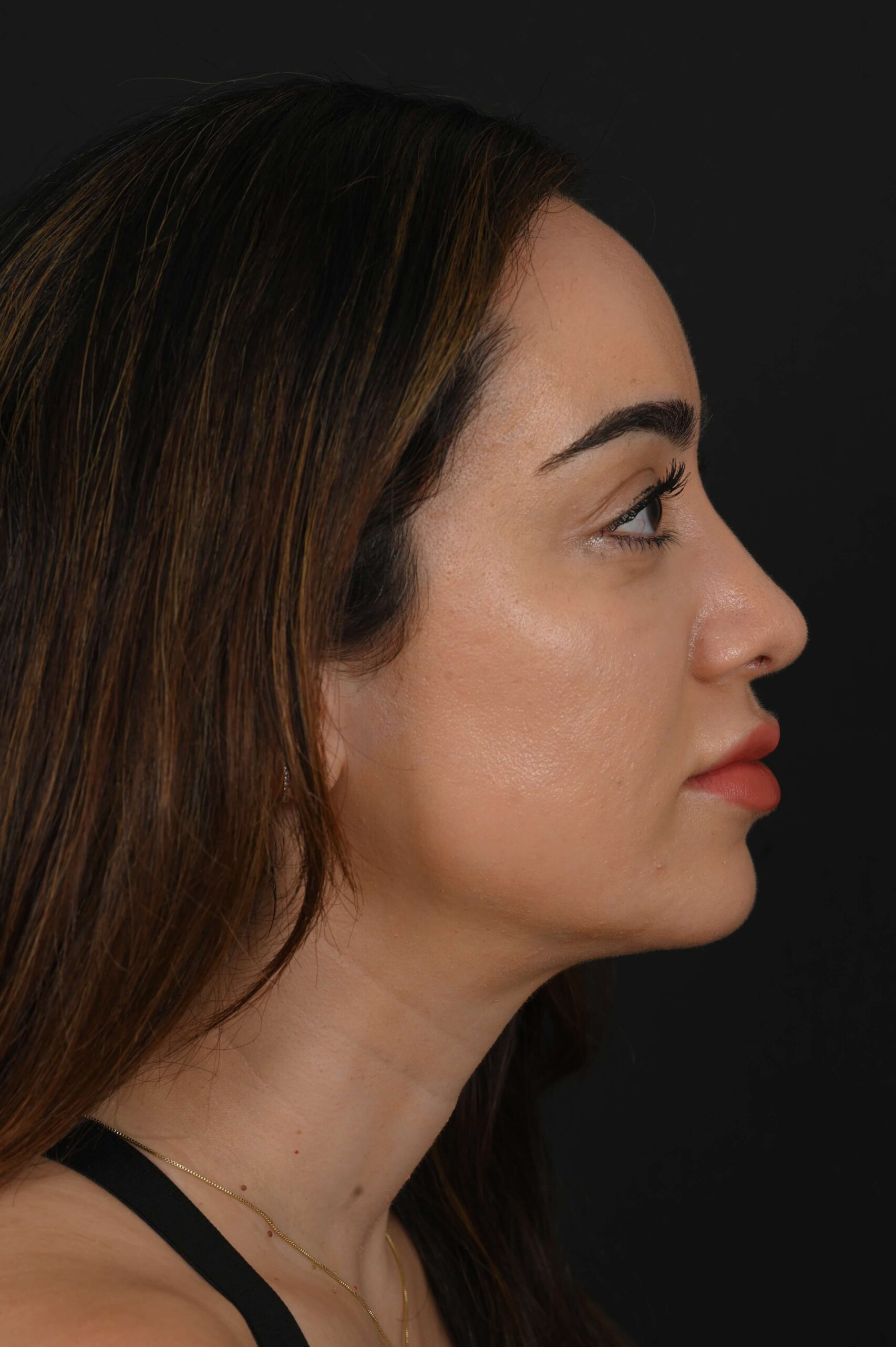 Female Middle Eastern rhinoplasty patient, before and after nose surgery by Houston nose surgeon Dr. Michel Siegel