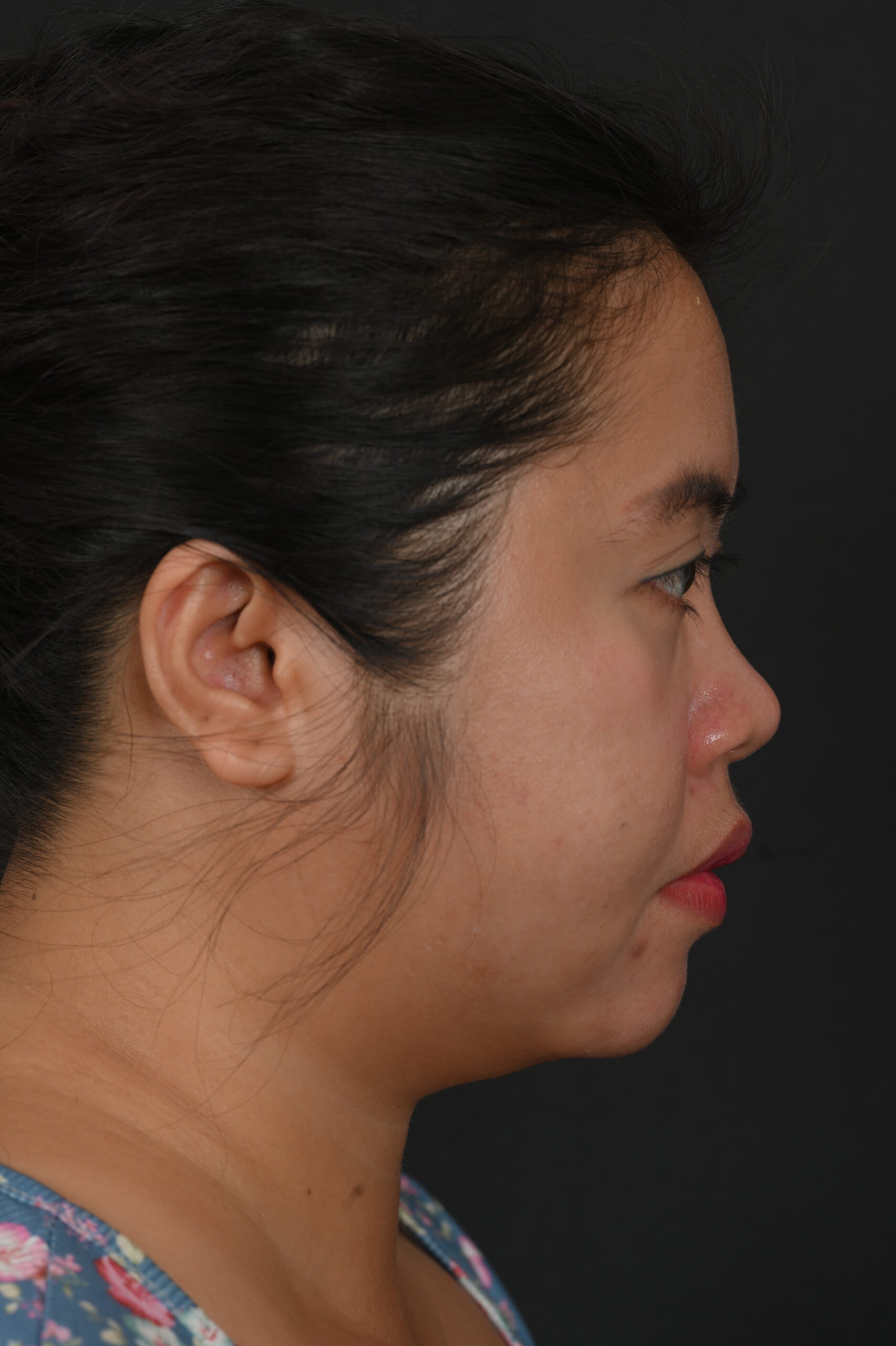 Female Asian rhinoplasty patient, before and after nose surgery by Houston nose surgeon Dr. Michel Siegel