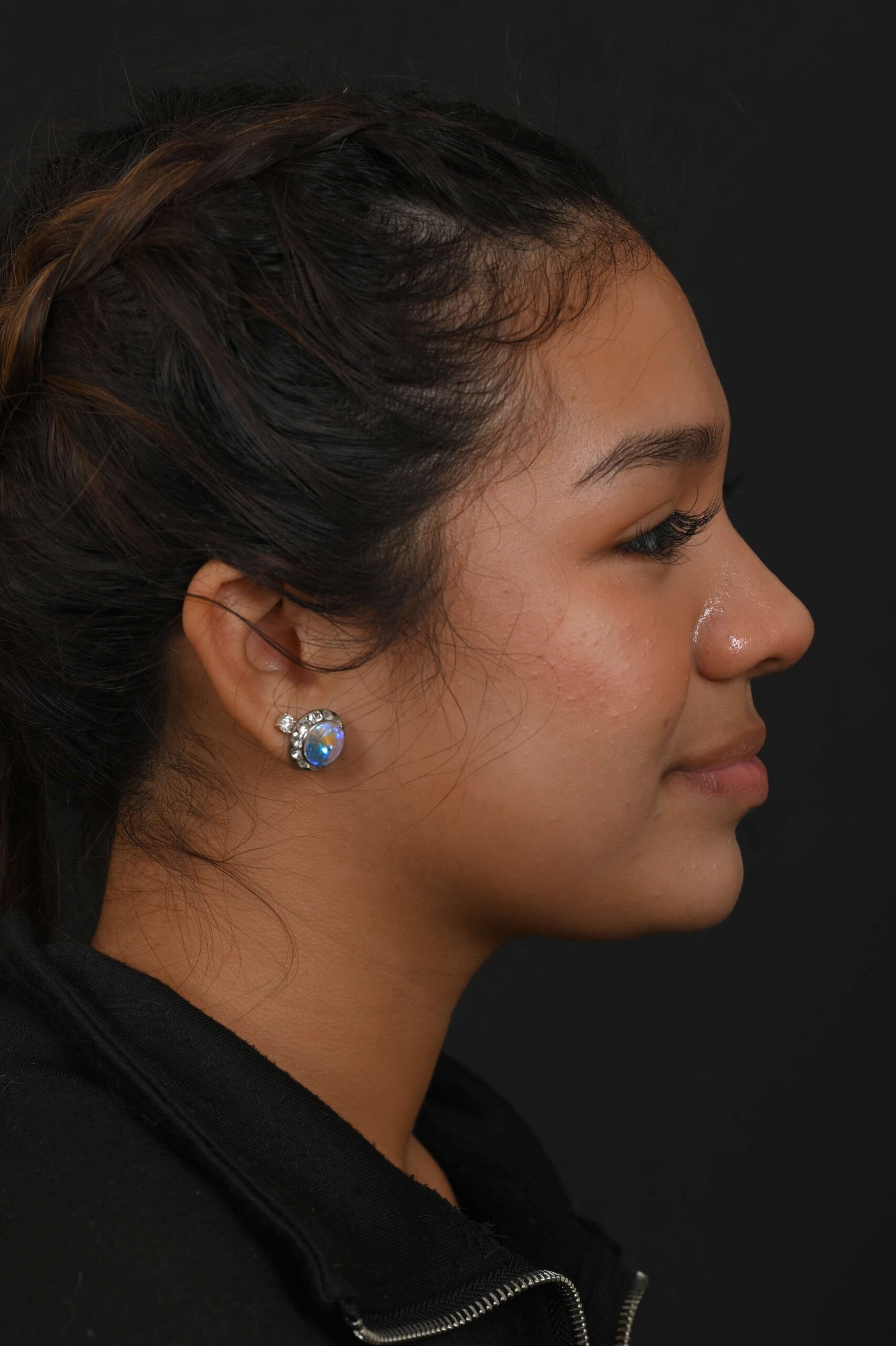 Latina rhinoplasty patient, before and after nose surgery by Houston nose surgeon Dr. Michel Siegel