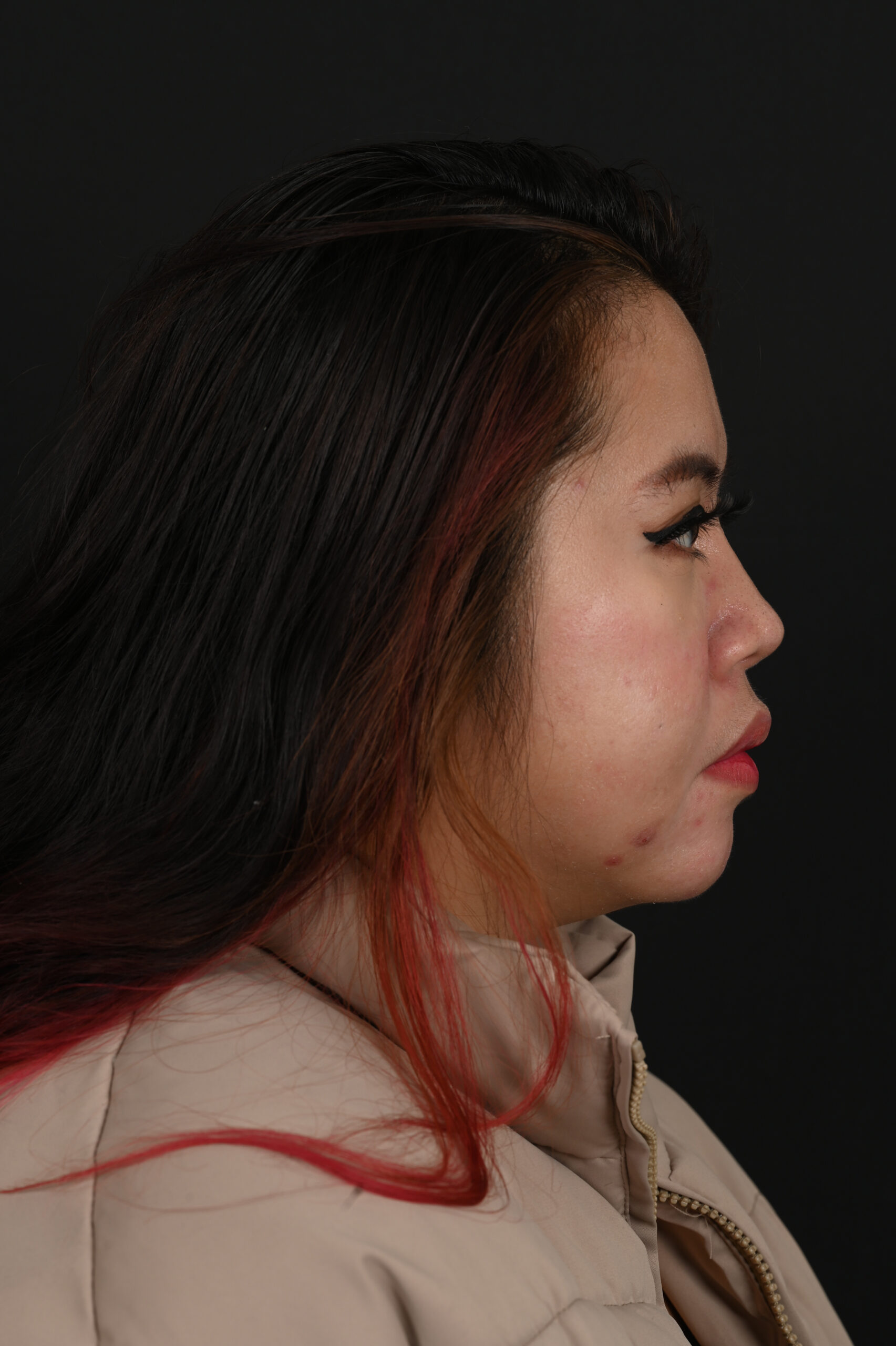 Female Asian rhinoplasty patient, before and after nose surgery by Houston nose surgeon Dr. Michel Siegel