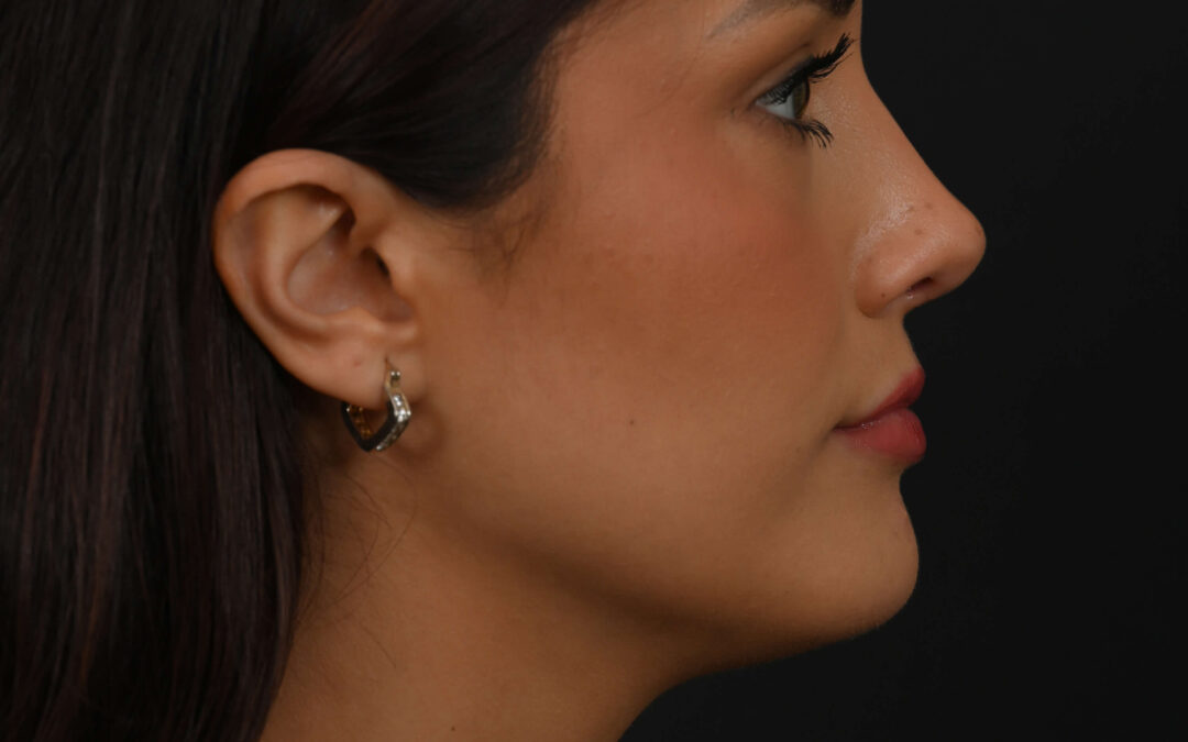 Latina rhinoplasty patient, before and after nose surgery by Houston nose surgeon Dr. Michel Siegel