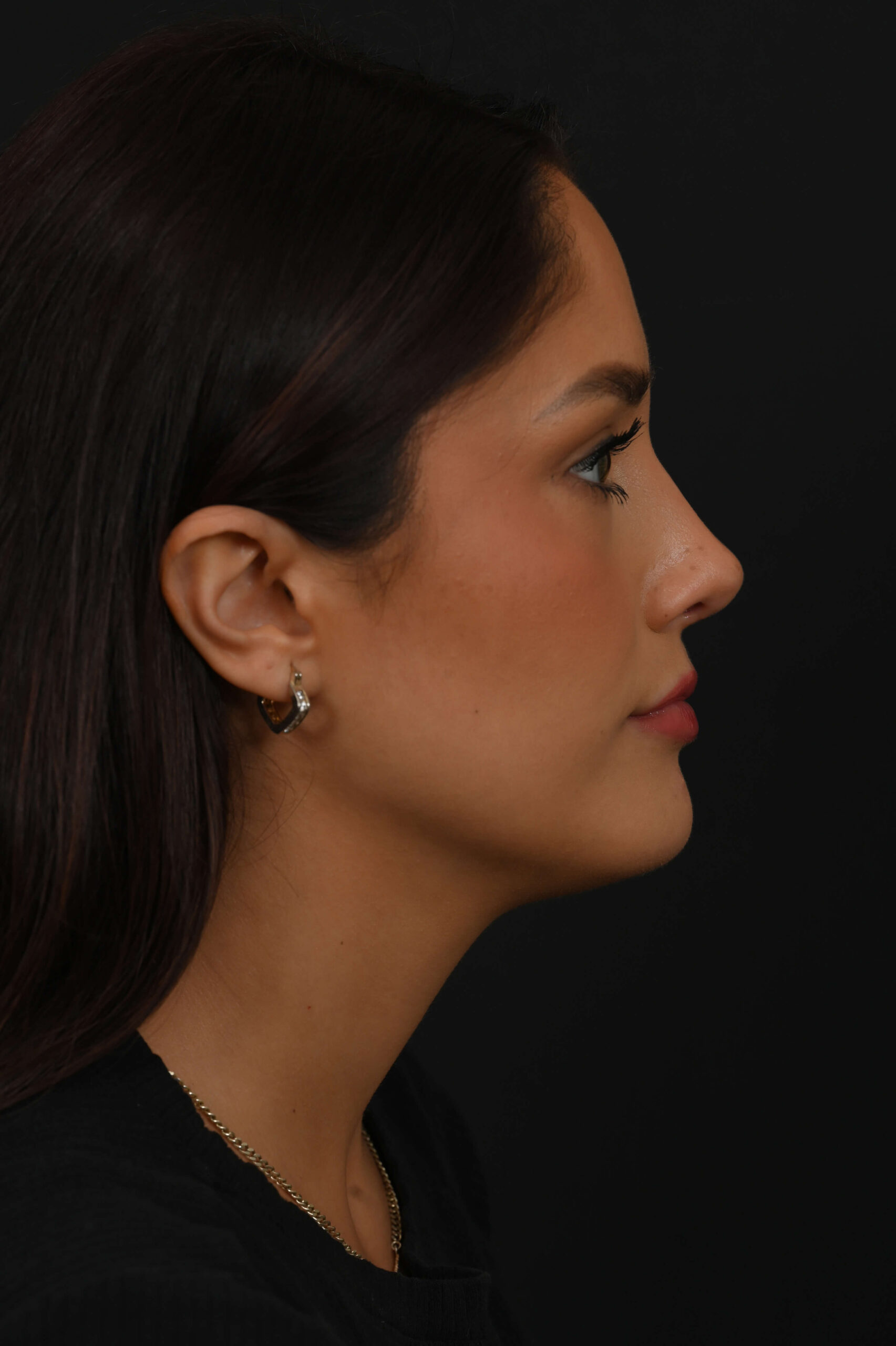 Latina rhinoplasty patient, before and after nose surgery by Houston nose surgeon Dr. Michel Siegel