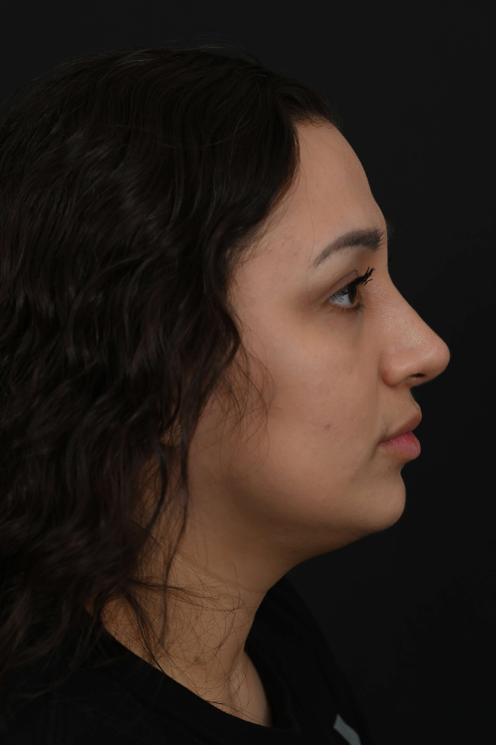 Latina rhinoplasty patient, before and after nose surgery by Houston nose surgeon Dr. Michel Siegel