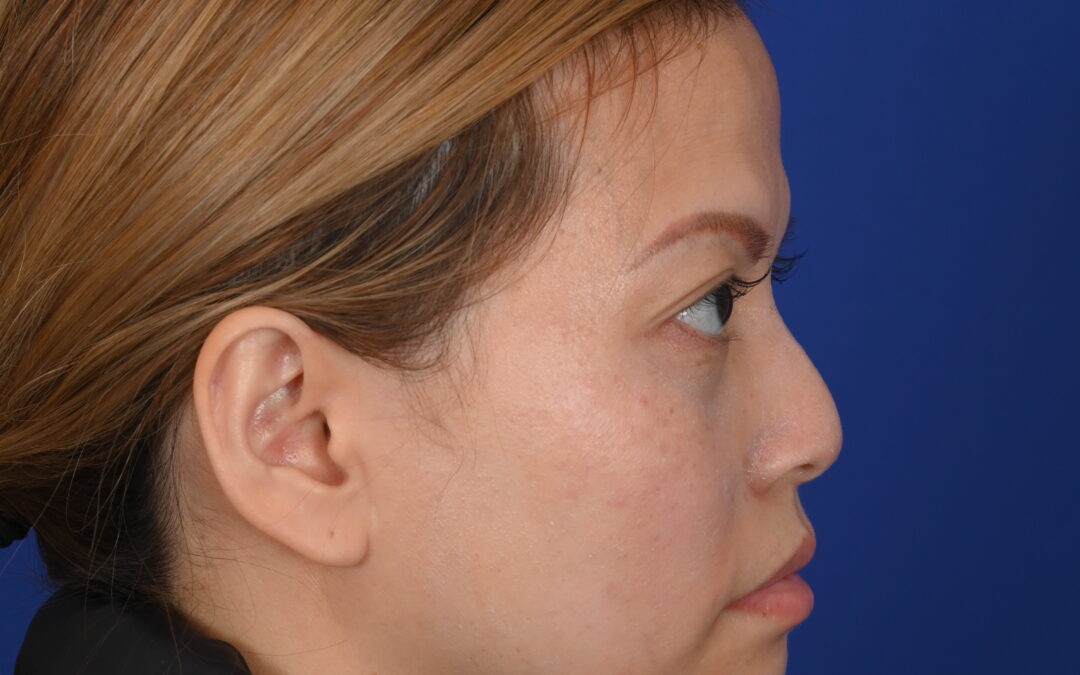 Female Asian rhinoplasty patient, before and after nose surgery by Houston nose surgeon Dr. Michel Siegel