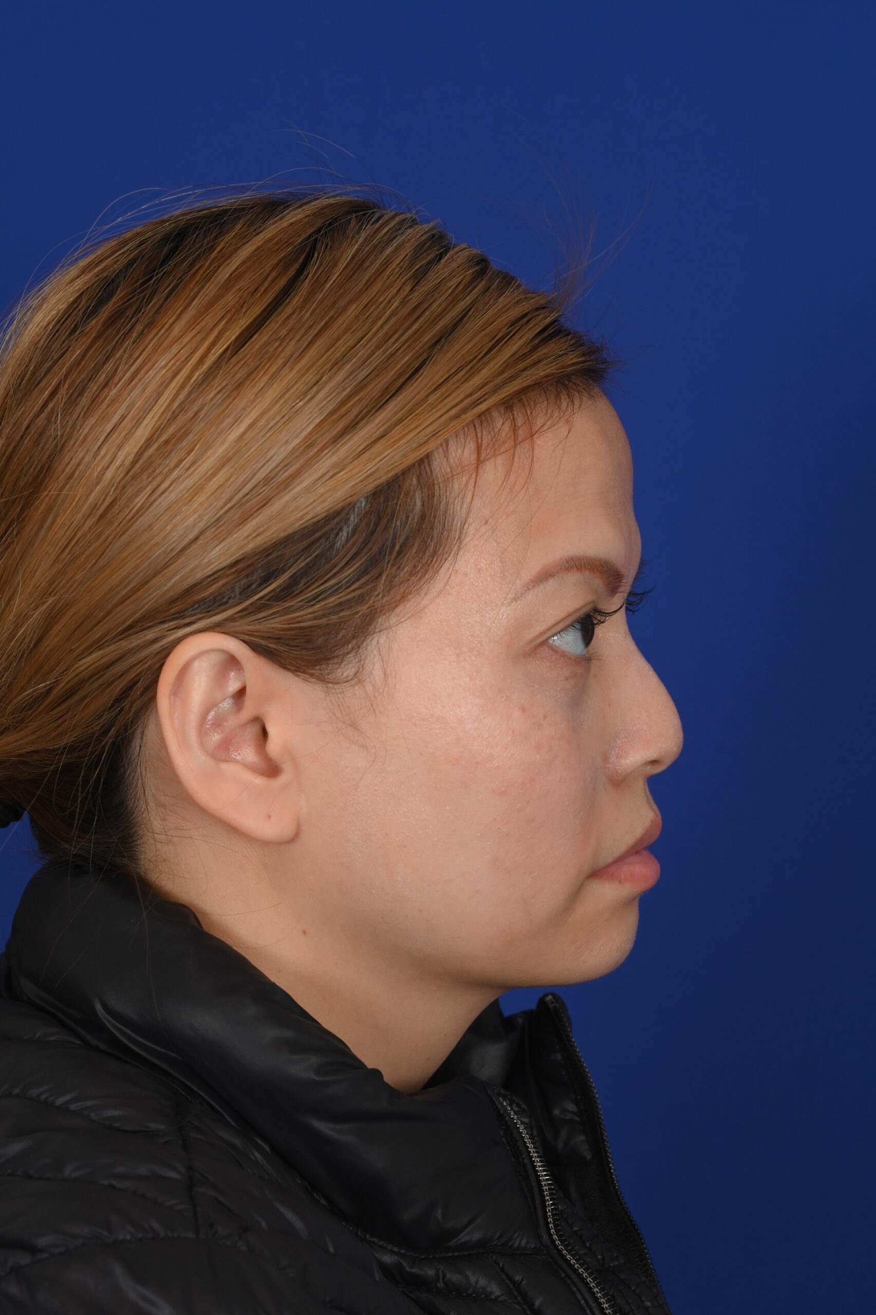 Female Asian rhinoplasty patient, before and after nose surgery by Houston nose surgeon Dr. Michel Siegel