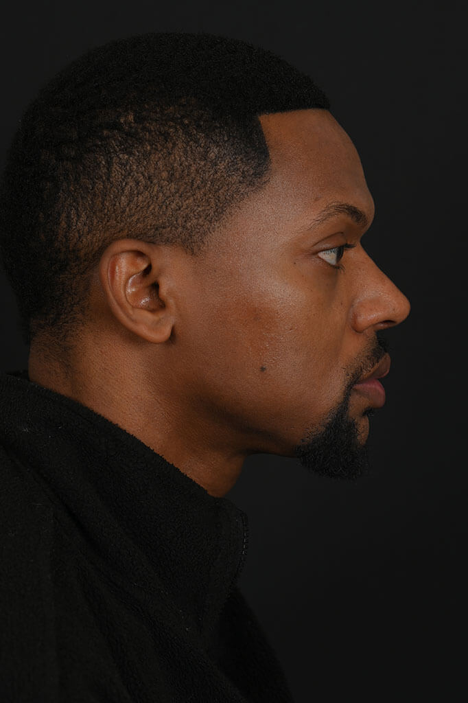 Black male rhinoplasty patient, before and after nose surgery by Houston nose surgeon Dr. Michel Siegel
