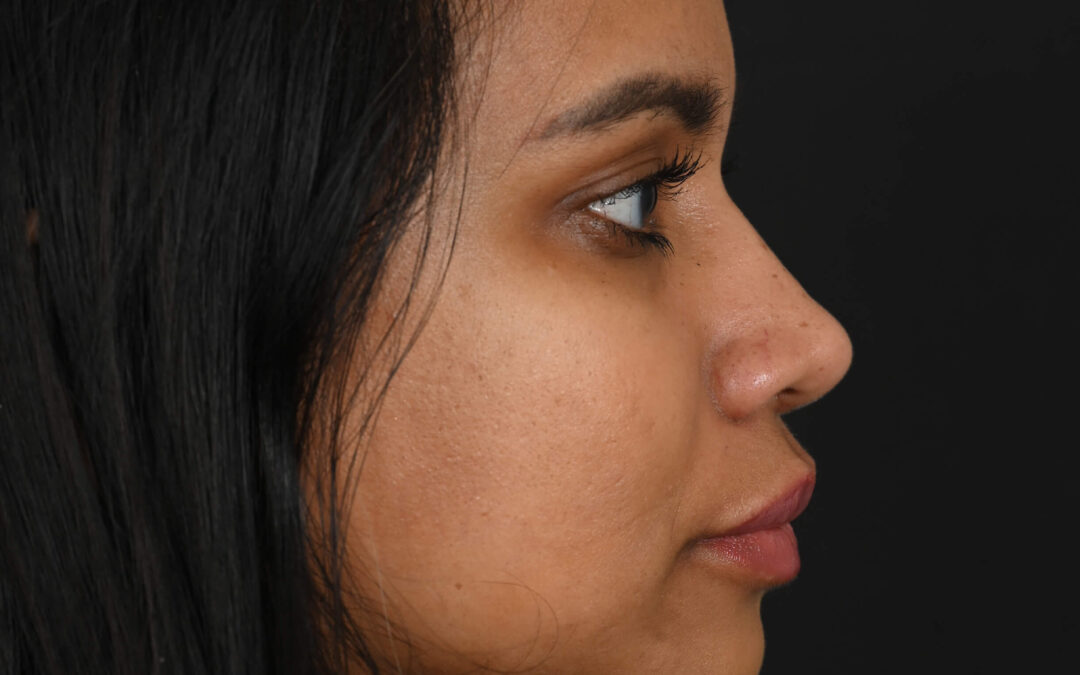 Female Middle Eastern rhinoplasty patient, before and after nose surgery by Houston nose surgeon Dr. Michel Siegel
