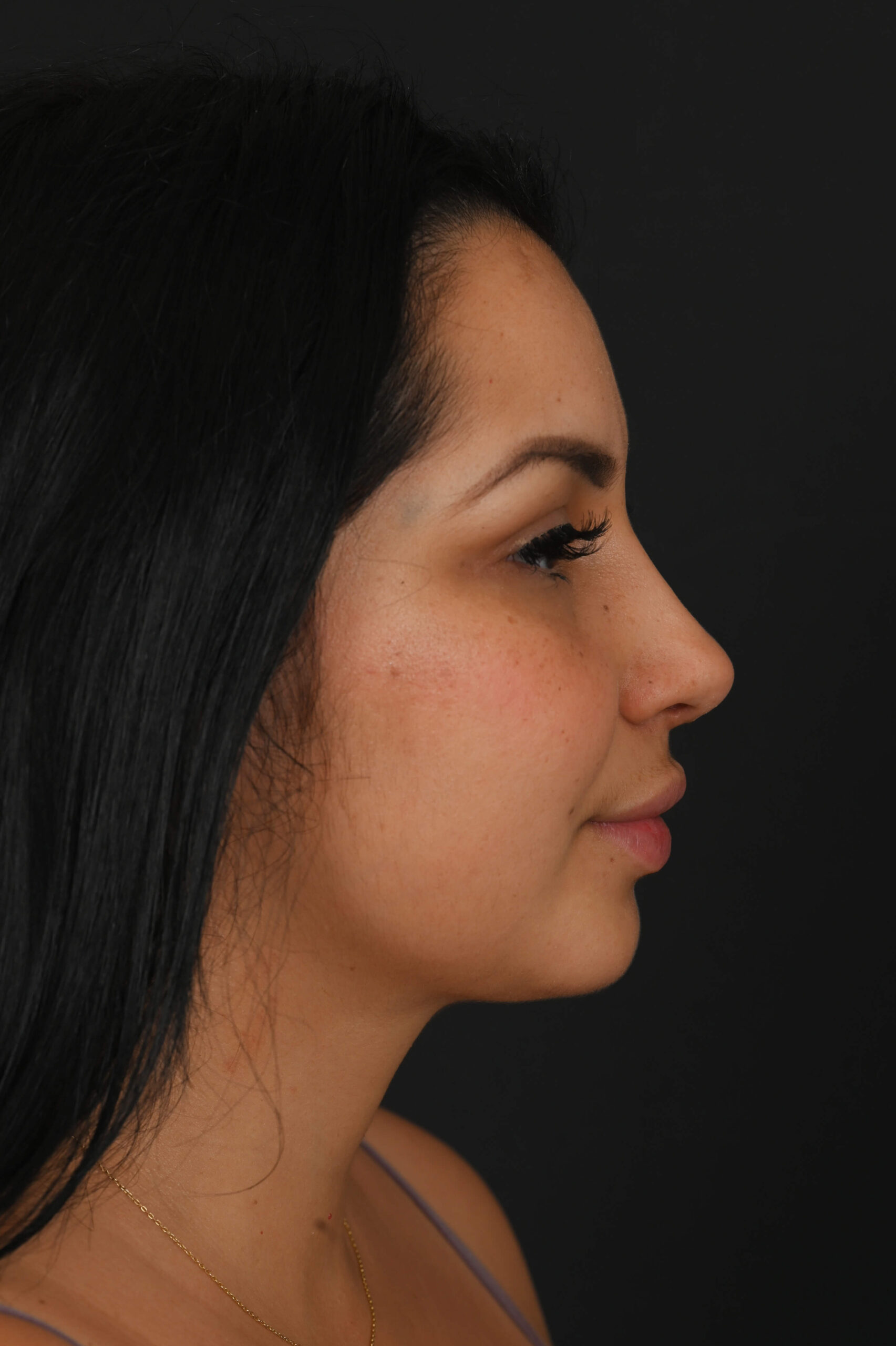 Latina rhinoplasty patient, before and after nose surgery by Houston nose surgeon Dr. Michel Siegel