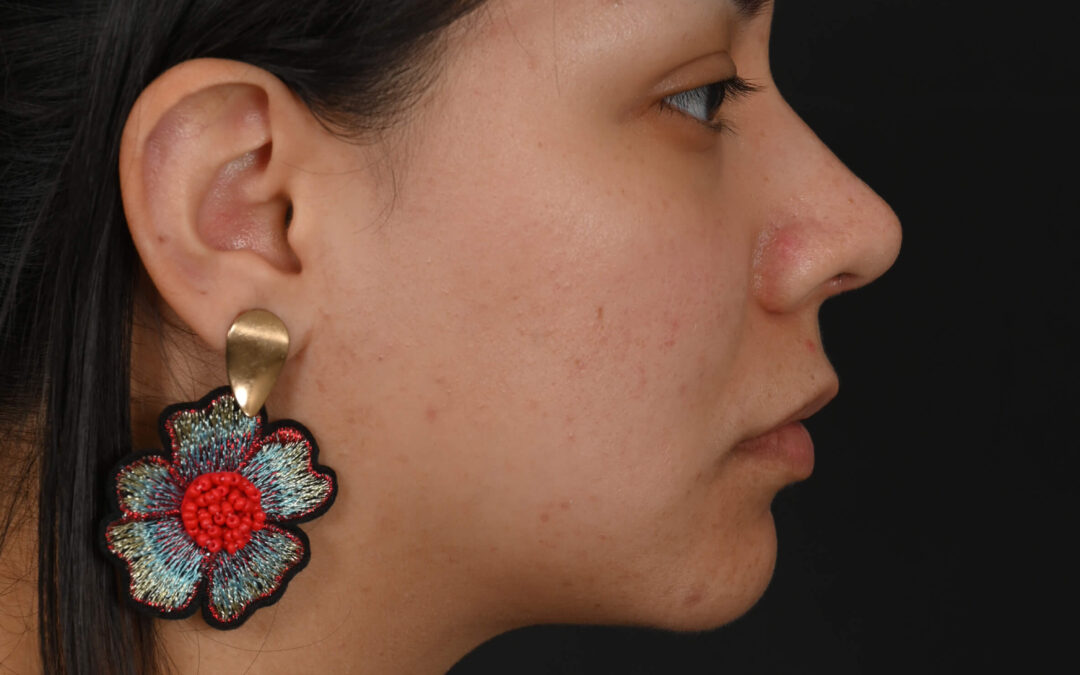 Latina rhinoplasty patient, before and after nose surgery by Houston nose surgeon Dr. Michel Siegel