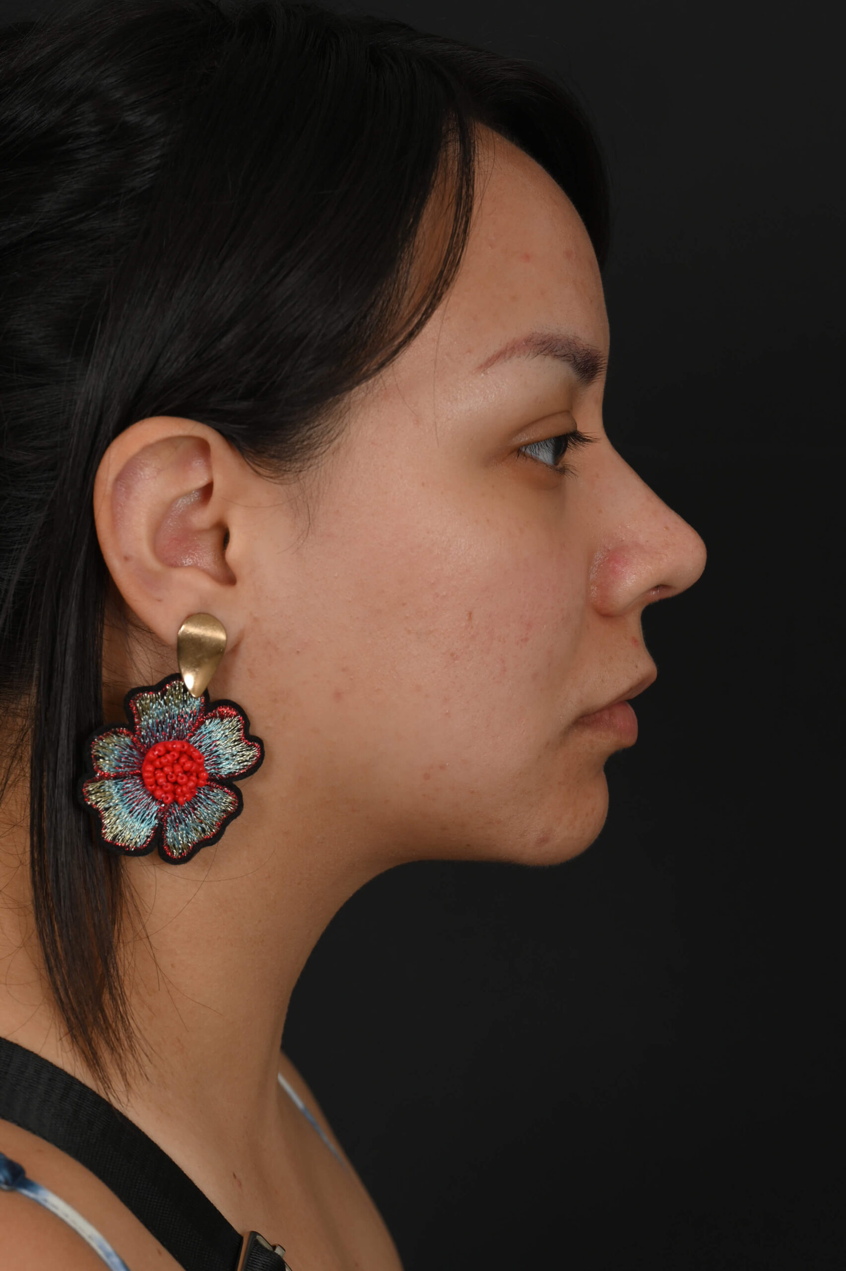 Latina rhinoplasty patient, before and after nose surgery by Houston nose surgeon Dr. Michel Siegel