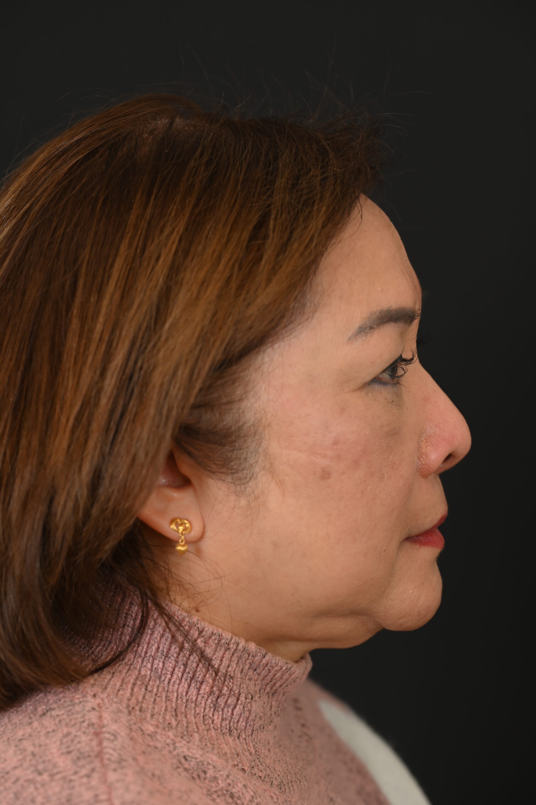 Female Asian rhinoplasty patient, before and after nose surgery by Houston nose surgeon Dr. Michel Siegel