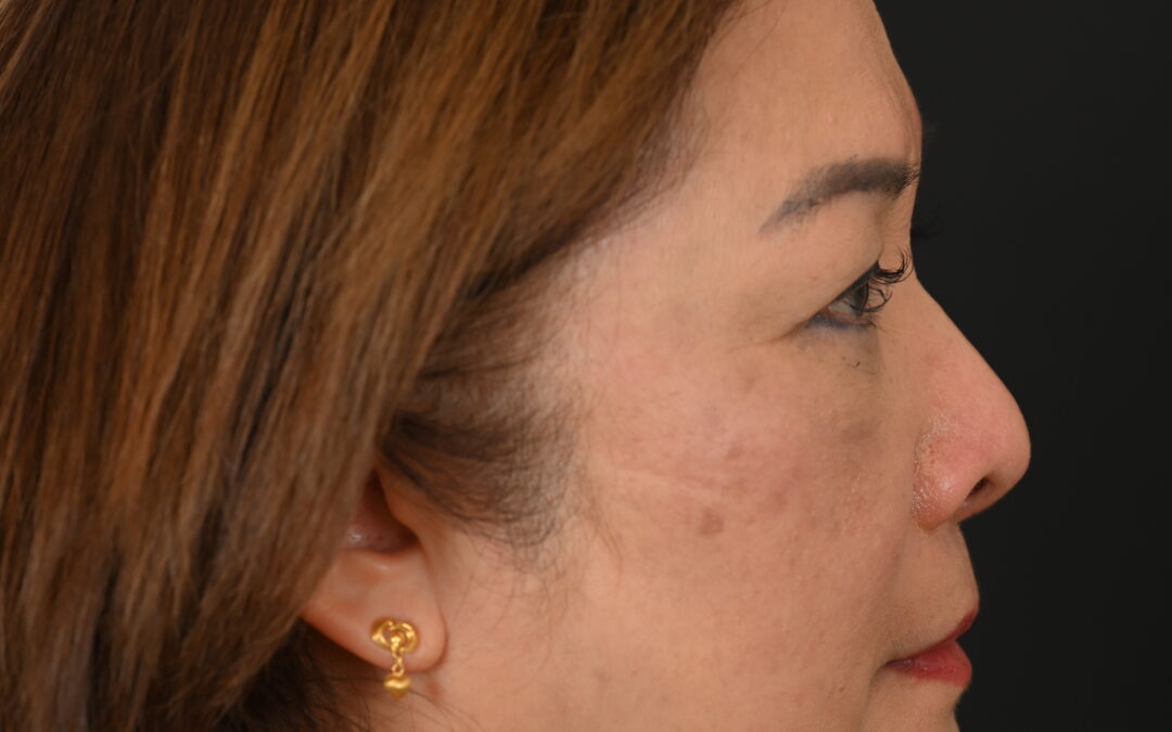 Female Asian rhinoplasty patient, before and after nose surgery by Houston nose surgeon Dr. Michel Siegel