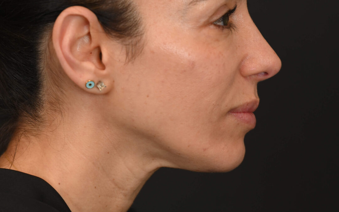 Female Middle Eastern rhinoplasty patient, before and after nose surgery by Houston nose surgeon Dr. Michel Siegel