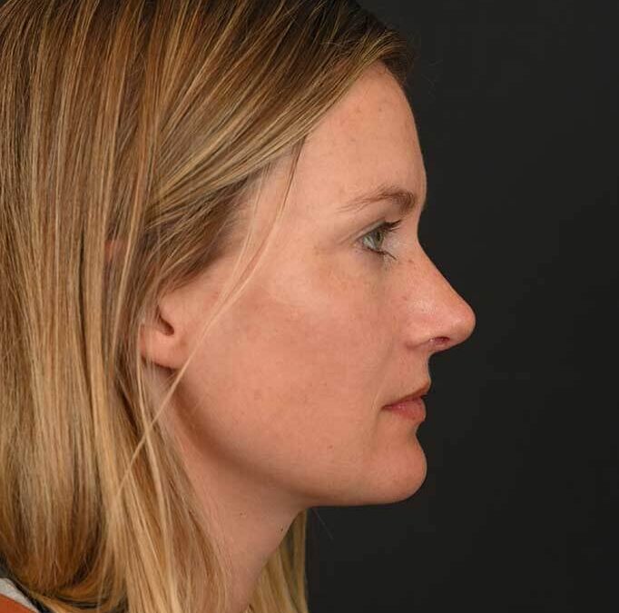 Female white rhinoplasty patient, before and after nose surgery by Houston nose surgeon Dr. Michel Siegel