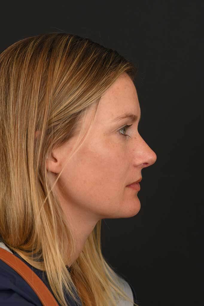 Female white rhinoplasty patient, before and after nose surgery by Houston nose surgeon Dr. Michel Siegel