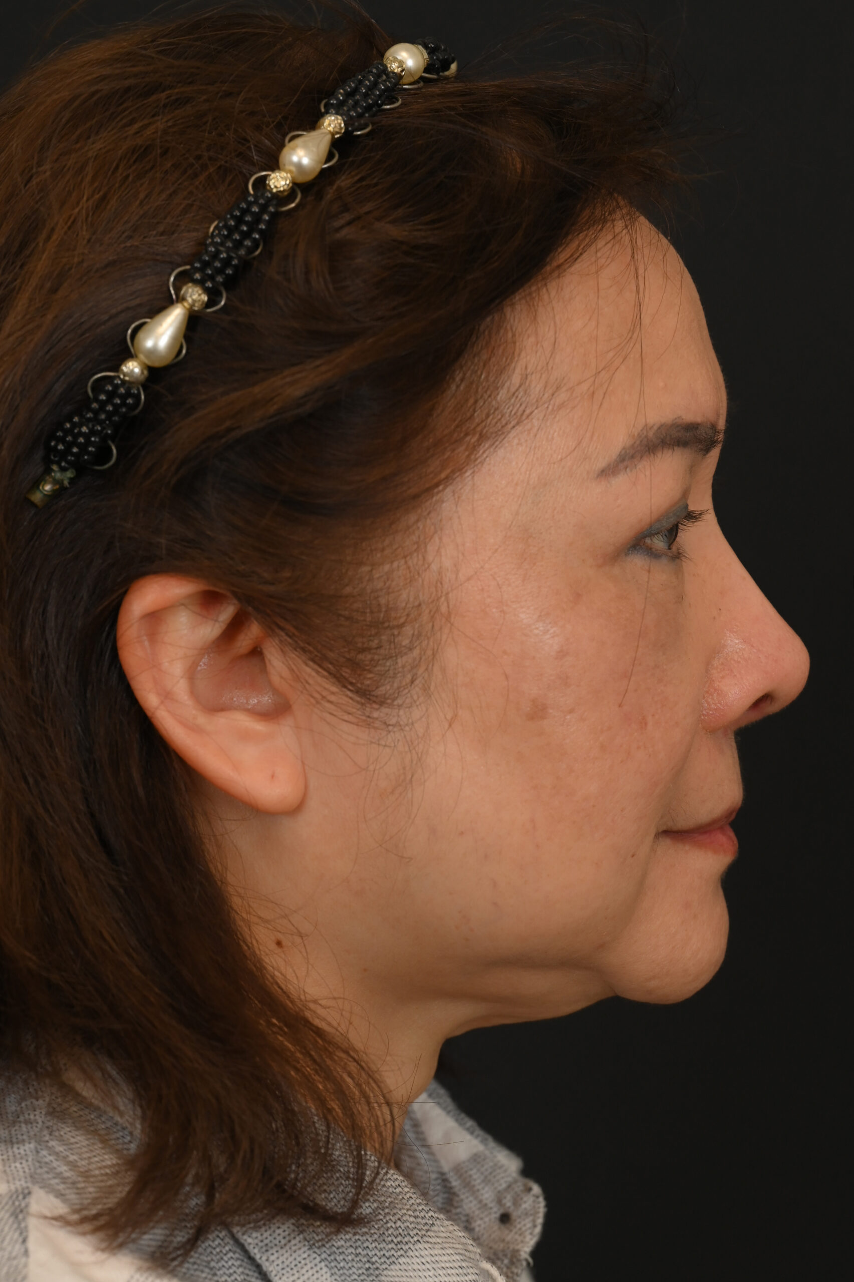 Female Asian rhinoplasty patient, before and after nose surgery by Houston nose surgeon Dr. Michel Siegel