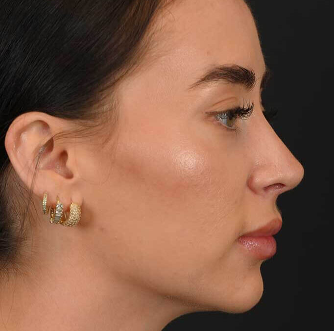 Female white rhinoplasty patient, before and after nose surgery by Houston nose surgeon Dr. Michel Siegel