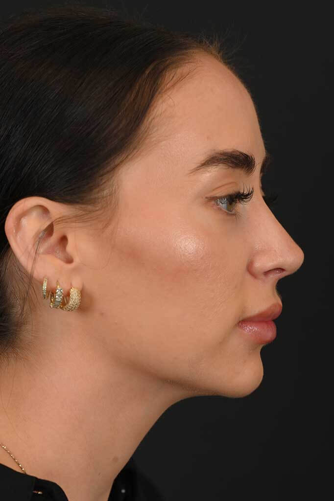 Female white rhinoplasty patient, before and after nose surgery by Houston nose surgeon Dr. Michel Siegel