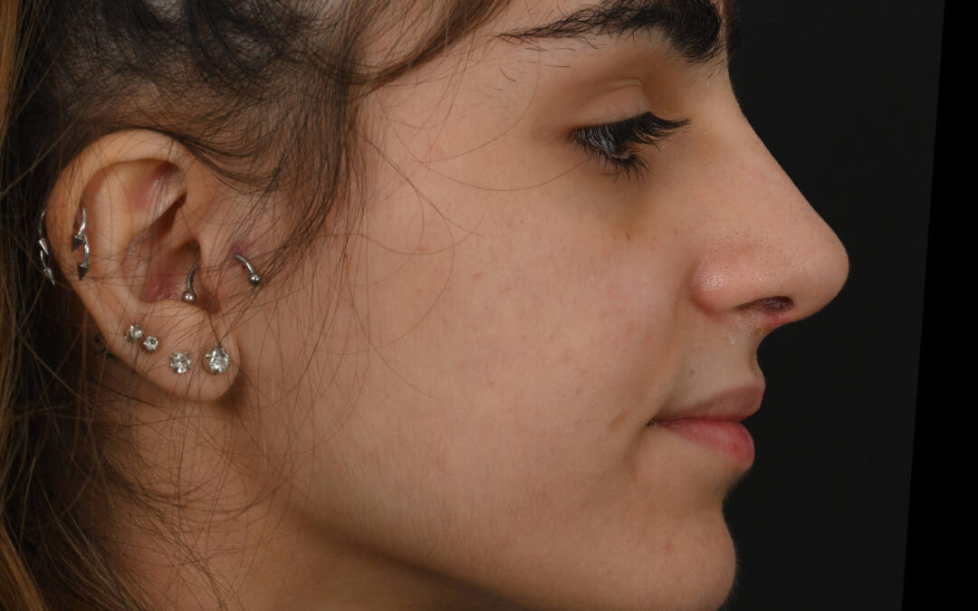 Female Middle Eastern rhinoplasty patient, before and after nose surgery by Houston nose surgeon Dr. Michel Siegel