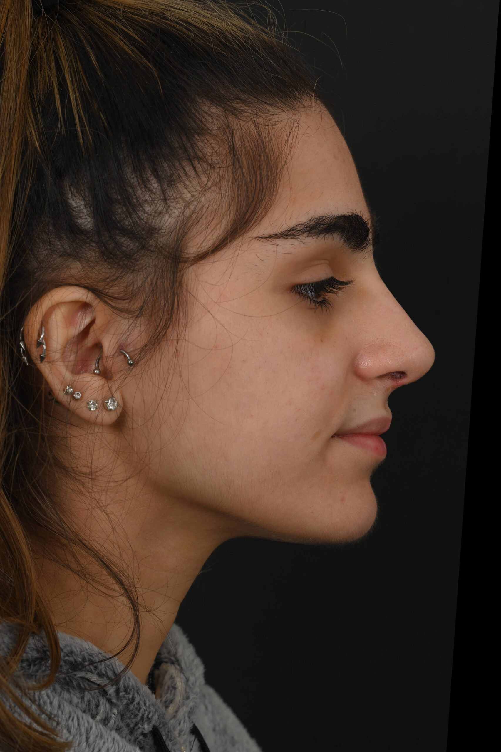 Female Middle Eastern rhinoplasty patient, before and after nose surgery by Houston nose surgeon Dr. Michel Siegel