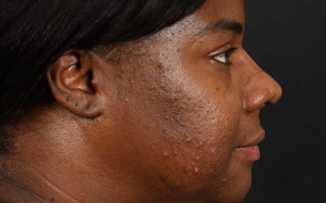 Black female rhinoplasty patient, before and after nose surgery by Houston nose surgeon Dr. Michel Siegel