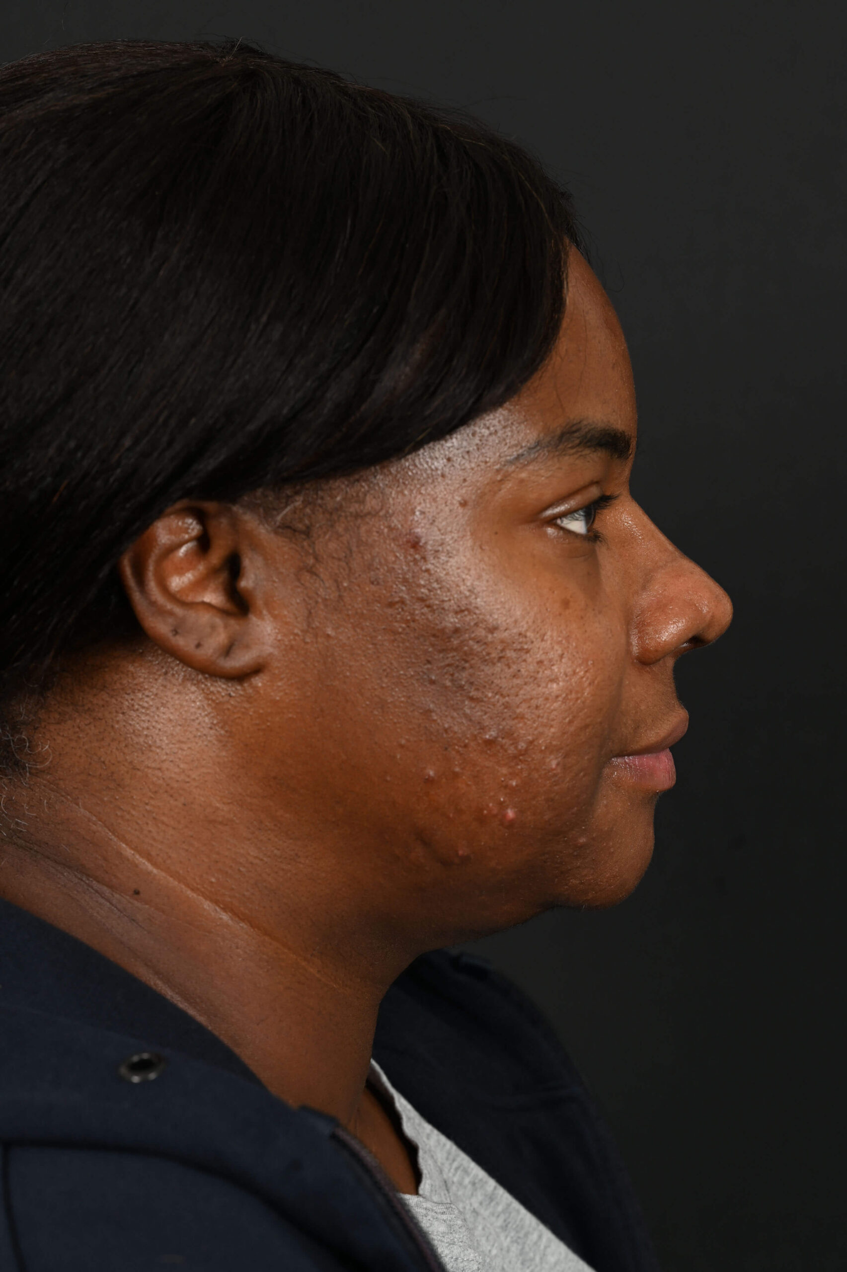 Black female rhinoplasty patient, before and after nose surgery by Houston nose surgeon Dr. Michel Siegel
