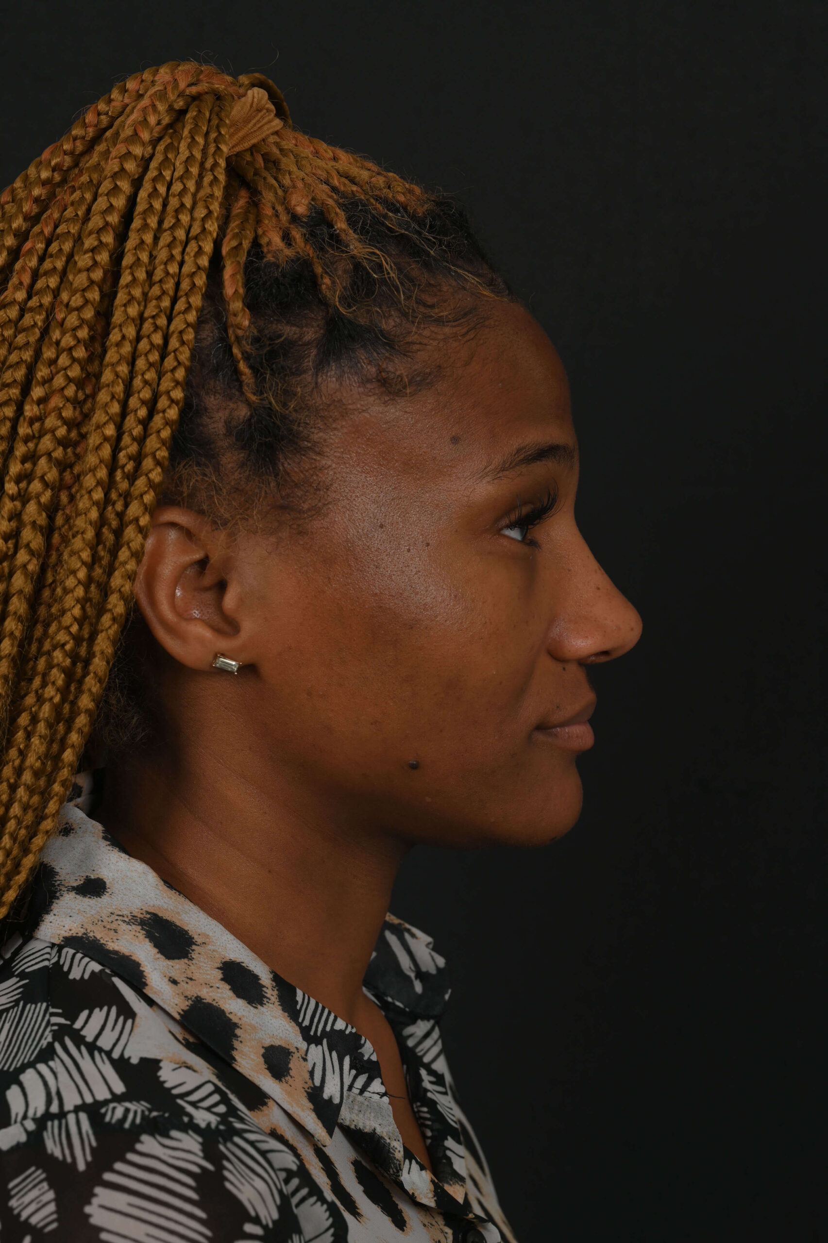 Black female rhinoplasty patient, before and after nose surgery by Houston nose surgeon Dr. Michel Siegel