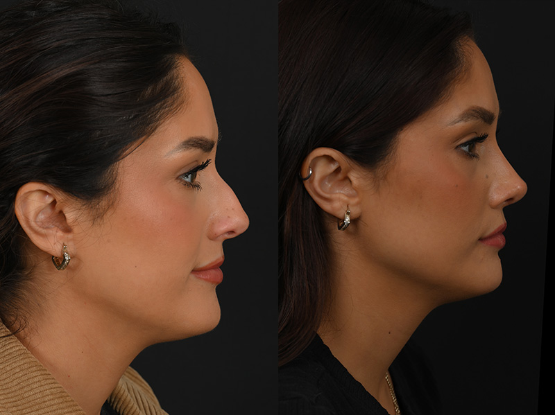 Rhinoplasty before and after