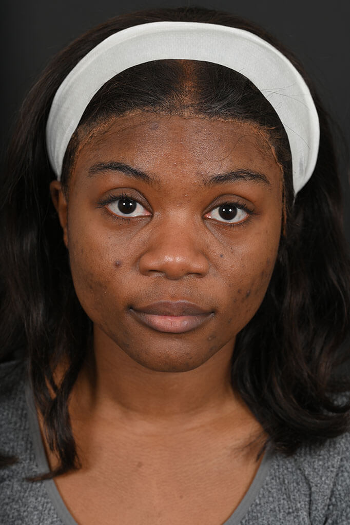 Black female rhinoplasty patient, before nose surgery by Houston nose surgeon Dr. Michel Siegel