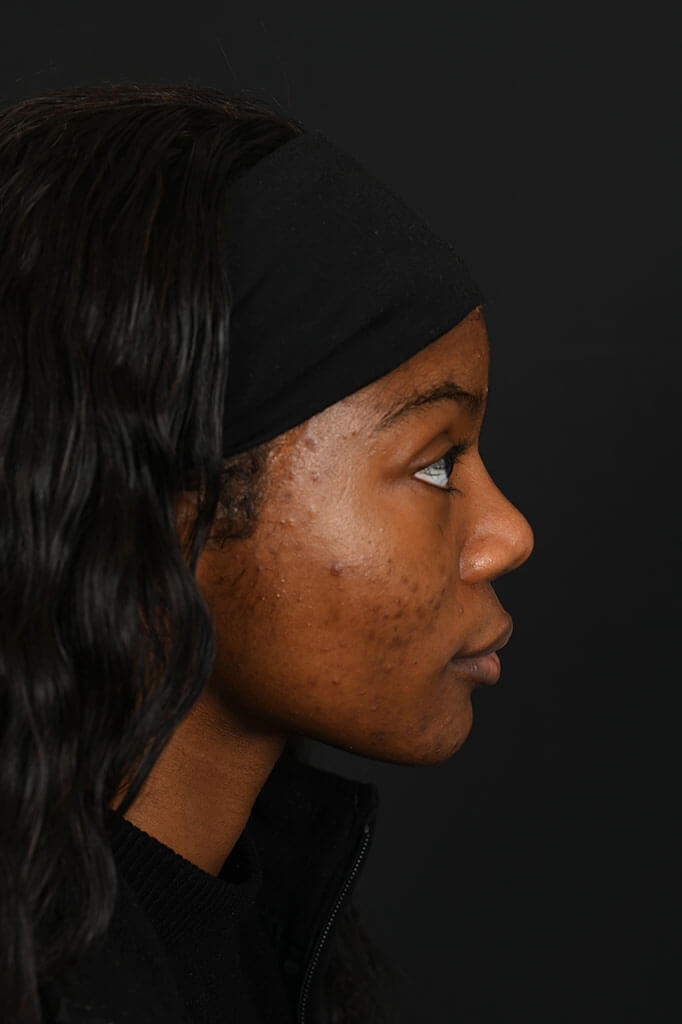 Black female rhinoplasty patient, before and after nose surgery by Houston nose surgeon Dr. Michel Siegel
