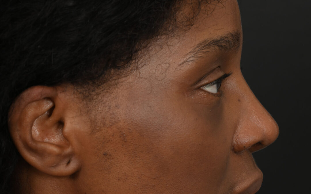 Black female rhinoplasty patient, before and after nose surgery by Houston nose surgeon Dr. Michel Siegel