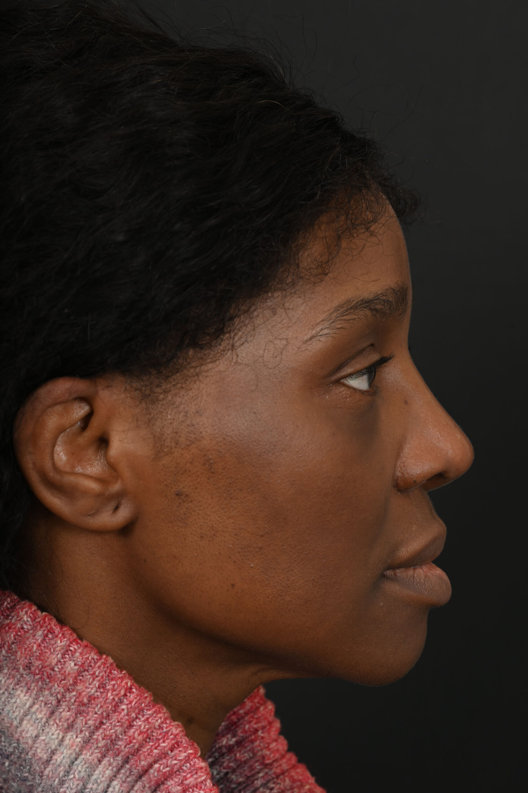 Black female rhinoplasty patient, before and after nose surgery by Houston nose surgeon Dr. Michel Siegel