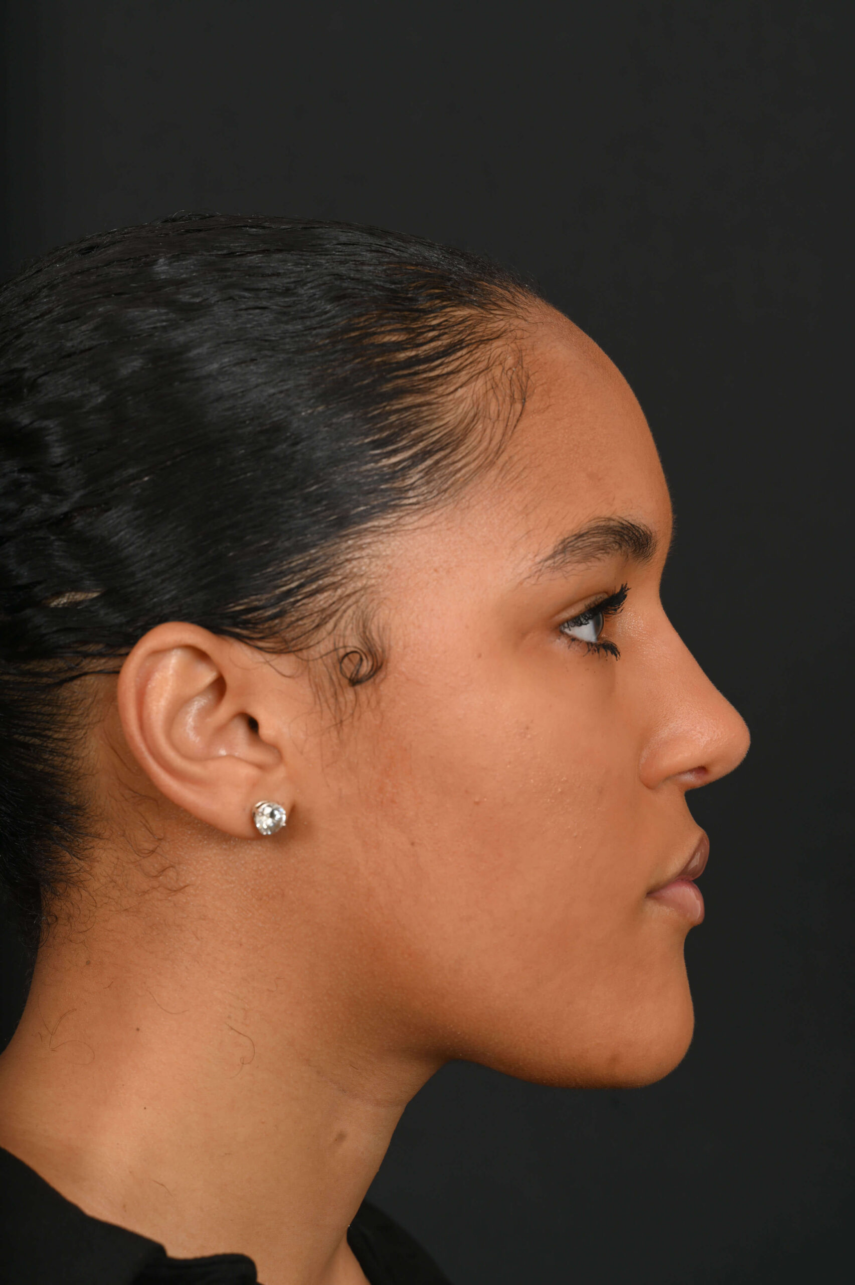 Black female rhinoplasty patient, before and after nose surgery by Houston nose surgeon Dr. Michel Siegel