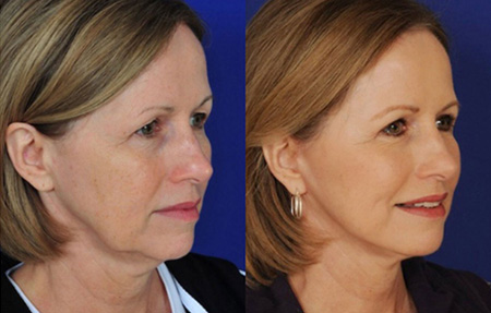 Neck lift results in Houston 