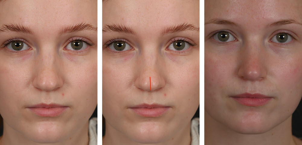 Bifid tip on nose example