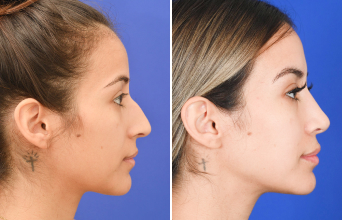 Female rhinoplasty before and after