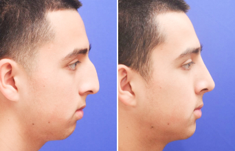 Male rhinoplasty before and after