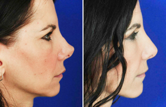 Female rhinoplasty before and after