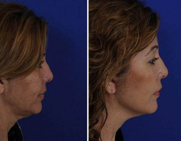 Be a More Youthful, Beautiful You! Benefits of a Facelift