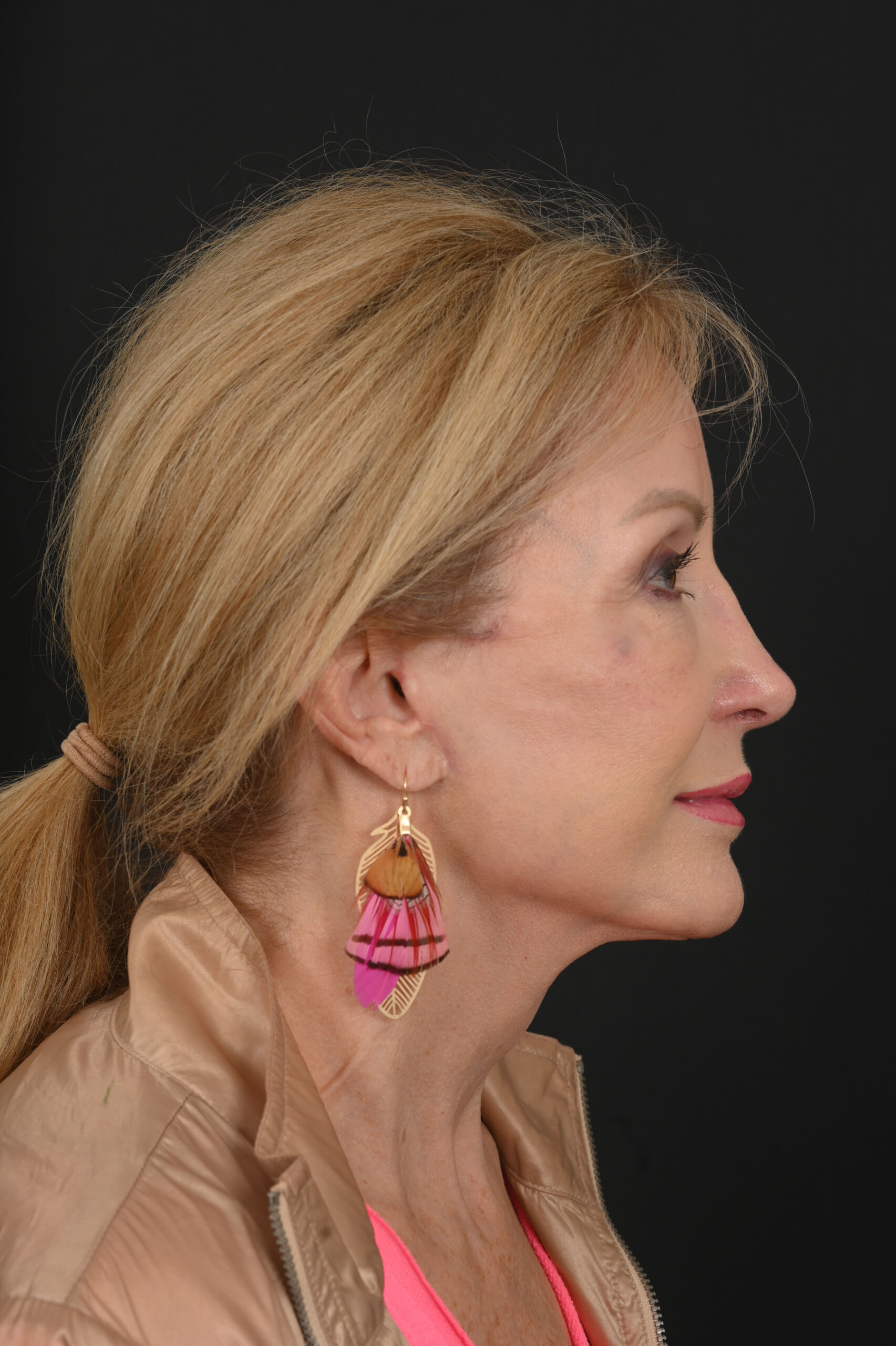 Face and Neck Lift 05