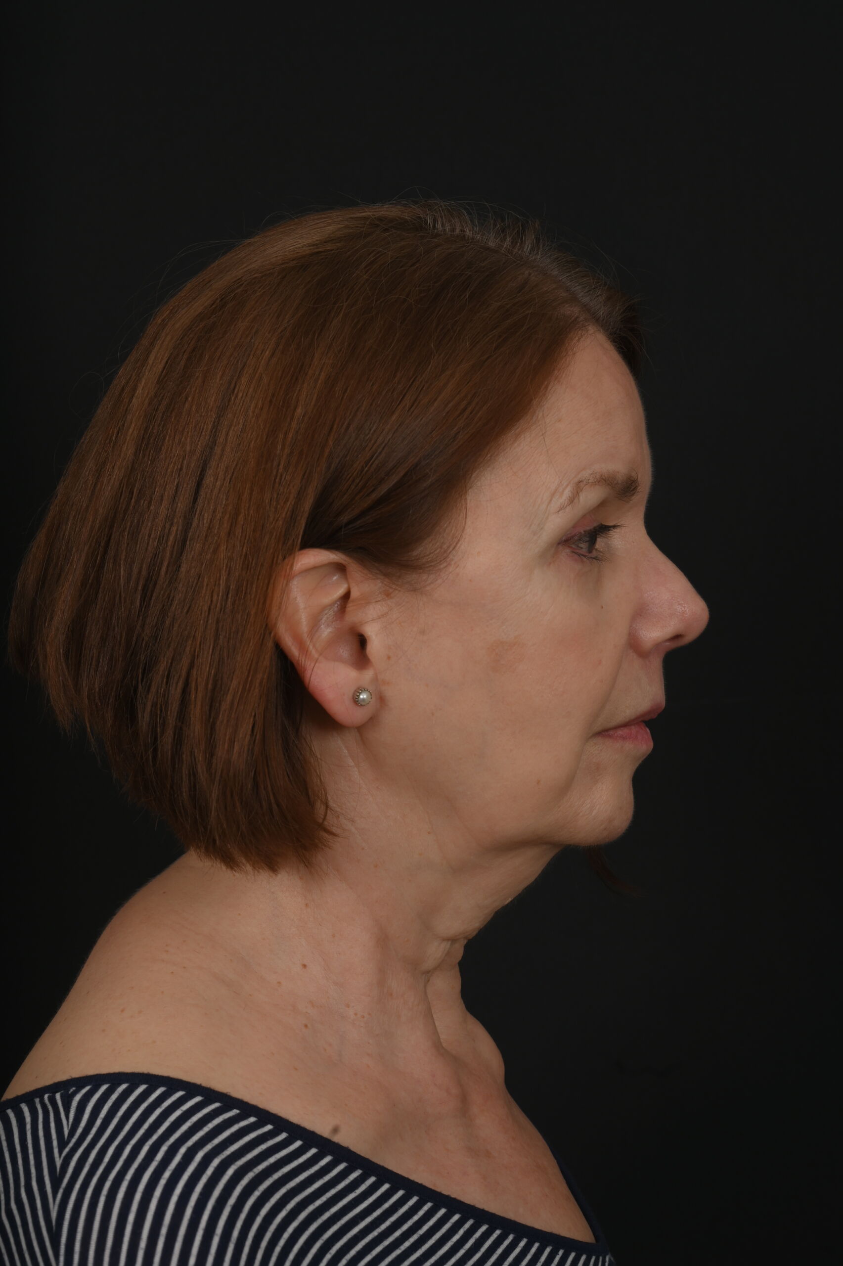 Face and Neck Lift 02