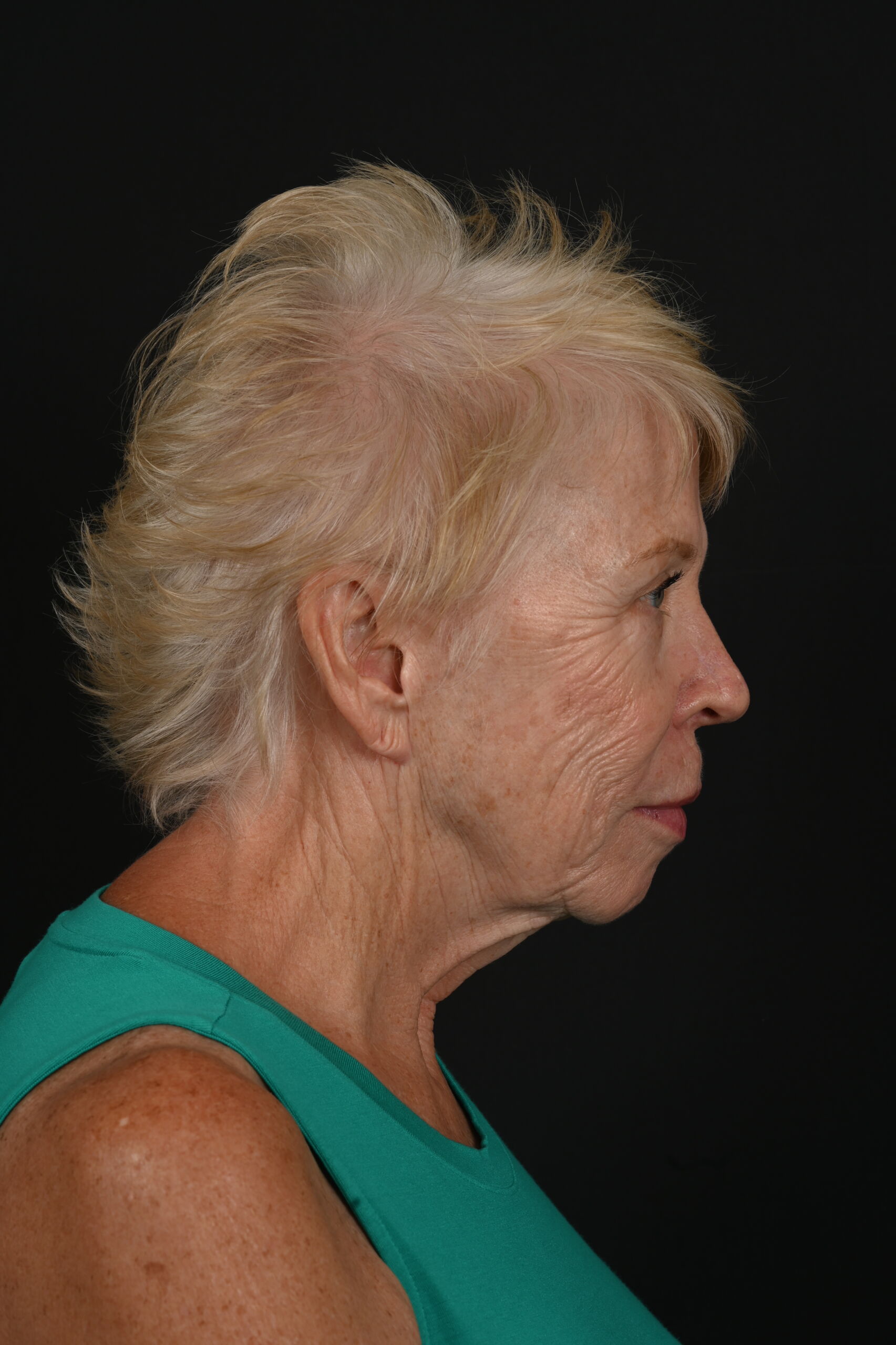 Face and Neck Lift 03